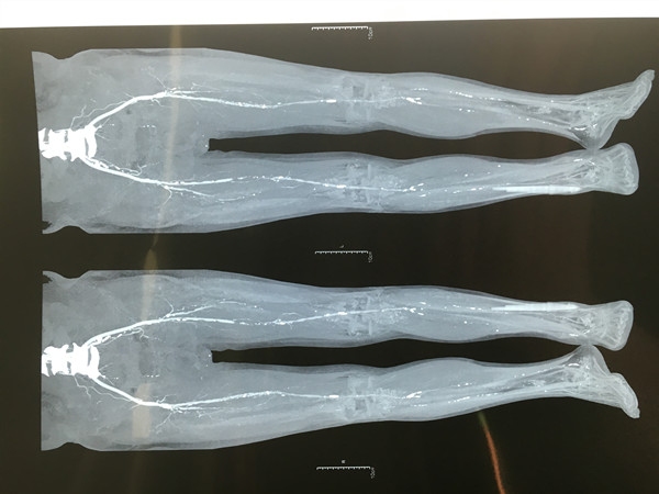 图2 术前双下肢CTA明确血管情况_副本.jpg